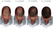 Finasteride timeline